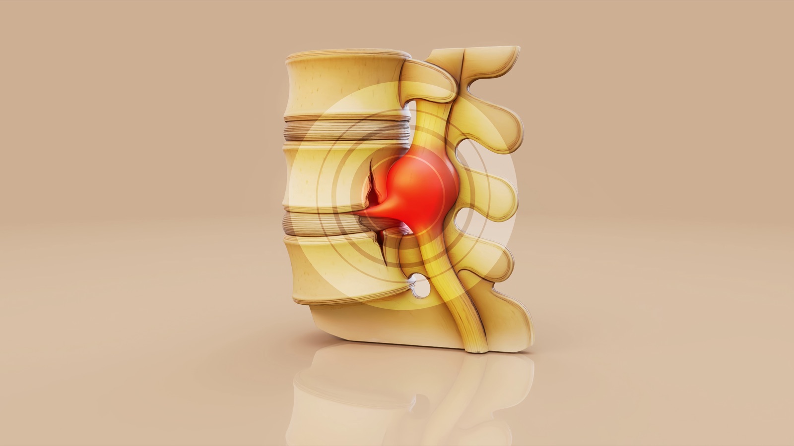 3D illustration of a herniated lumbar disc pressing on a nerve